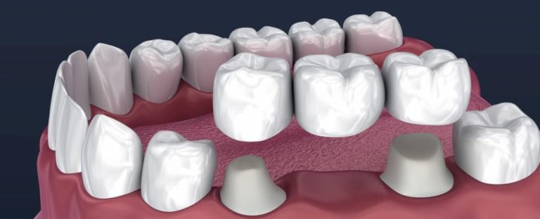 Puente dental Tipos y precios Clínica Dental Tacna