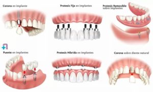 Prótesis fija Tipos y Materiales Clínica Dental Tacna