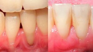 Injerto De Enc As Tratamientos Cl Nica Dental Tacna