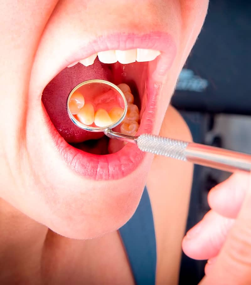 Tipos de infecciones dentales