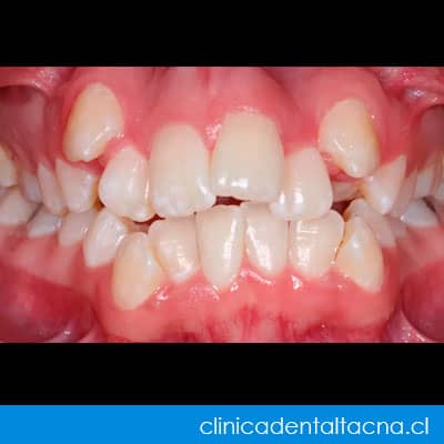 Odontología en Tacna 4 brackets metalicos economicos