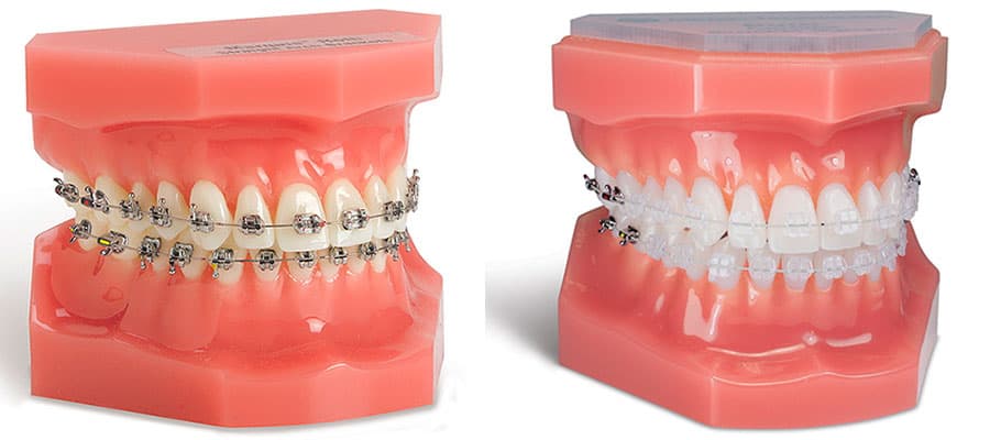 diferencia entre brackets metalicos y esteticos