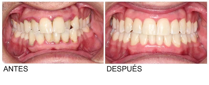 brackets antes y despues