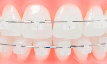 brackets de autoligado estetico