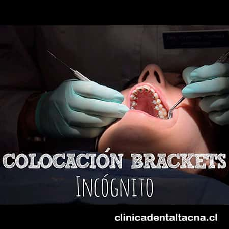 colocacion de brackets linguales