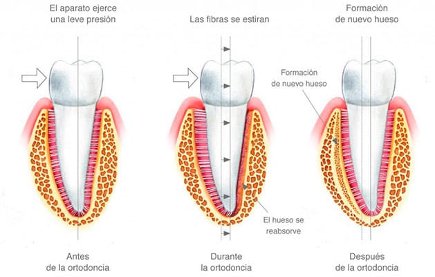 como se mueven los dientes con brackets