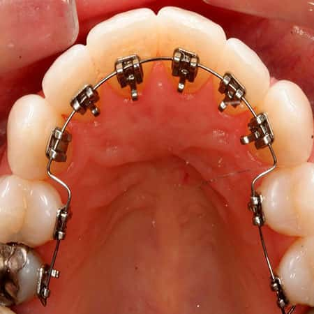 como funcionan los brackets linguales