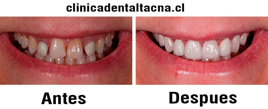 estética dental antes y despues