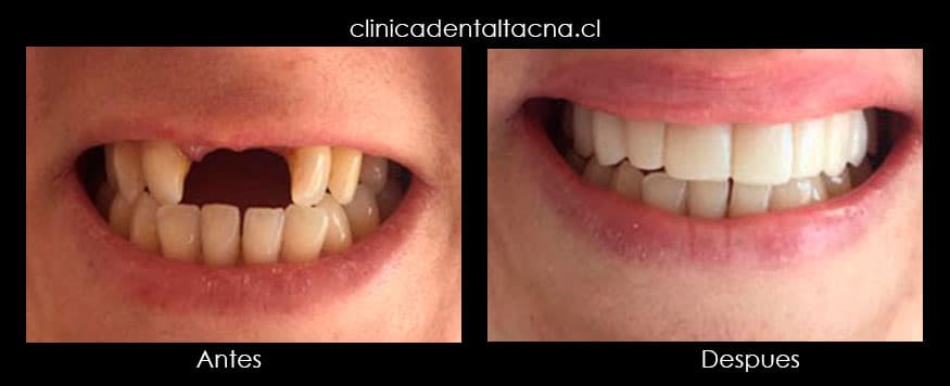 ✓ Tipos de dientes postizos - Dentistas Por Chile
