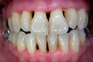 periodontitis piorrea