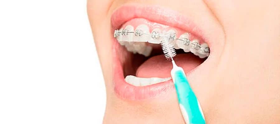 recomendaciones para los brackets esteticos