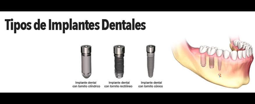▷ Corona dental  Tipos y precios - Clínica Dental Tacna