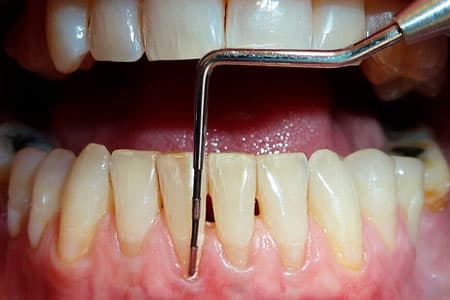 tratamiento periodontal