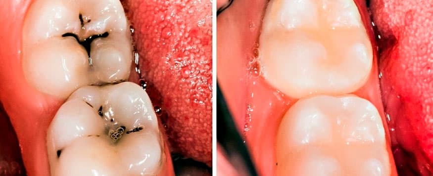 caries dental antes y despues