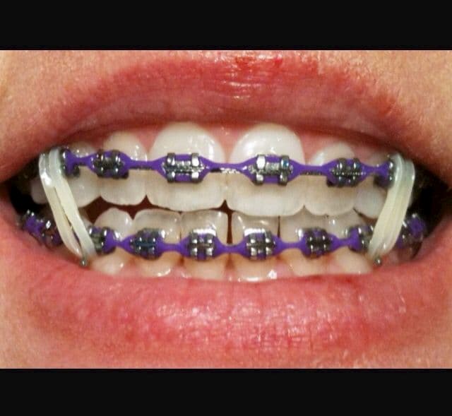 brackets para la maloclusion