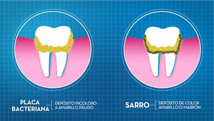 diferencia entre placa bacteriana y sarro