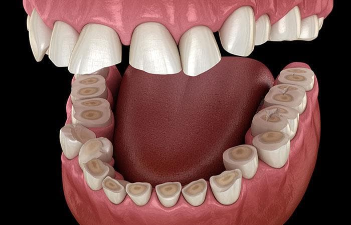 ¿Que es la abfracción dental? Causas y Tratamientos - Clínica Dental Tacna