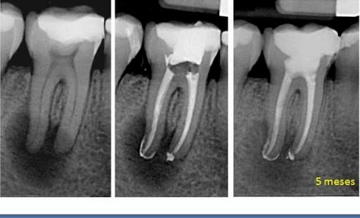 endodoncia antes y despues