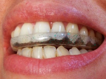 El Bruxismo. Importancia de la férula dental — clínica dental tonicollar