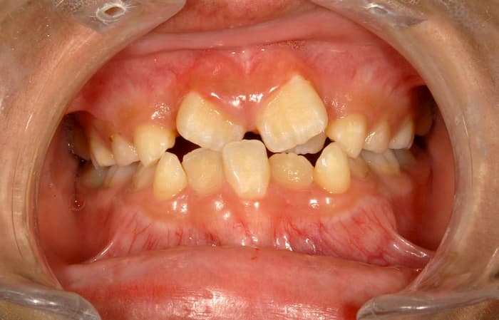 maloclusion dental