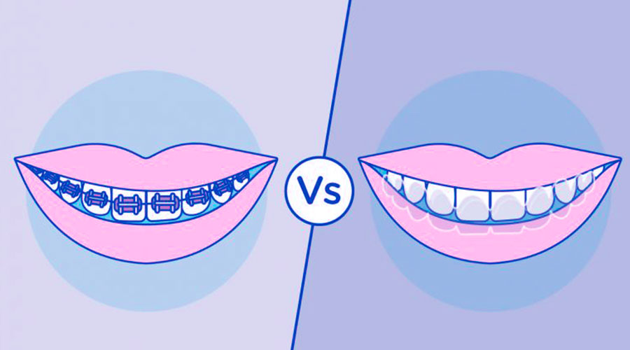 ortodoncia removible vs ortodoncia fija