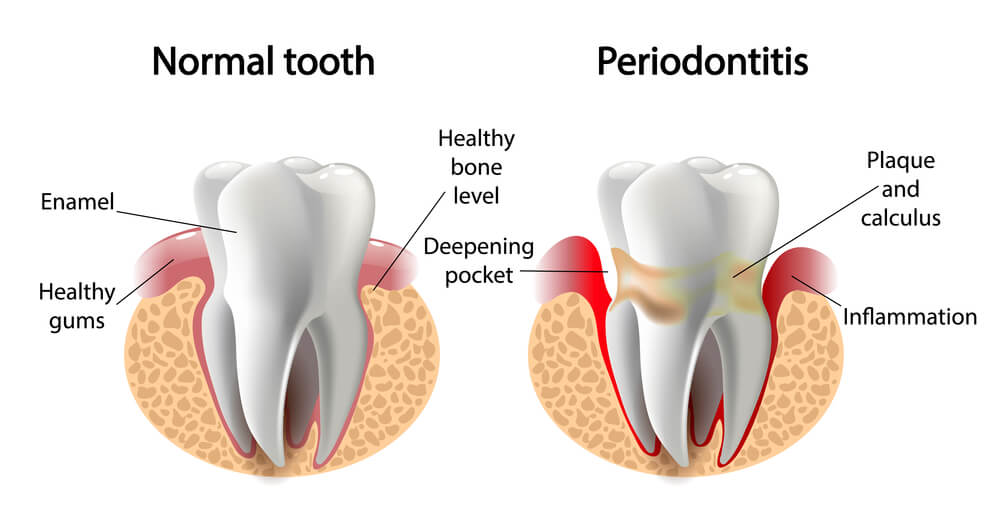 Síntomas de la periodontitis y su tratamiento 2 que es la periodontitis