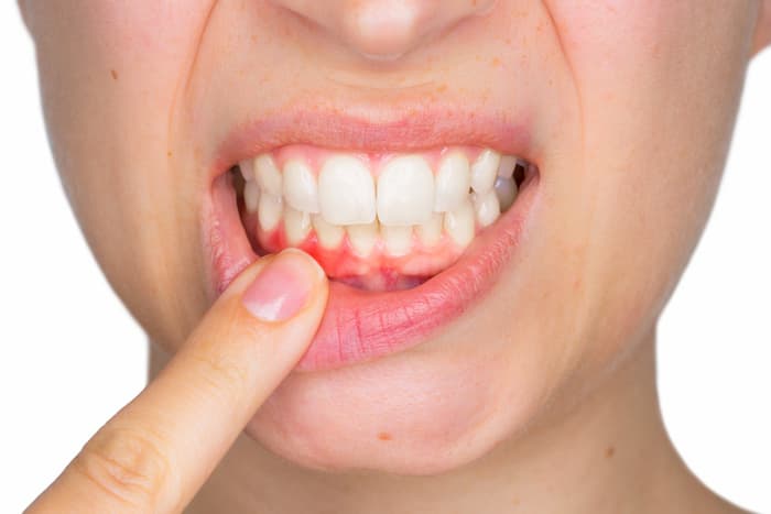 sintomas de la periodontitis