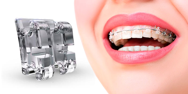 Brackets de Zafiro 1 Brackets de Zafiro 1