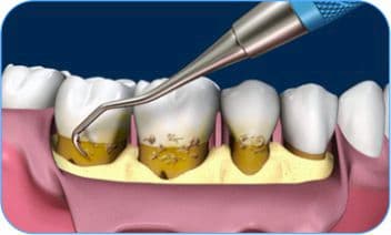 cirugia periodontal con colgajo