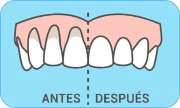 injerto de encias