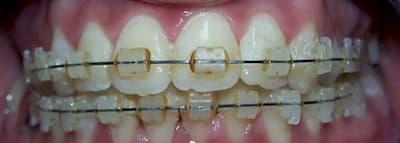 Recomendaciones y cuidados con brackets 10 cambio de color de gomas
