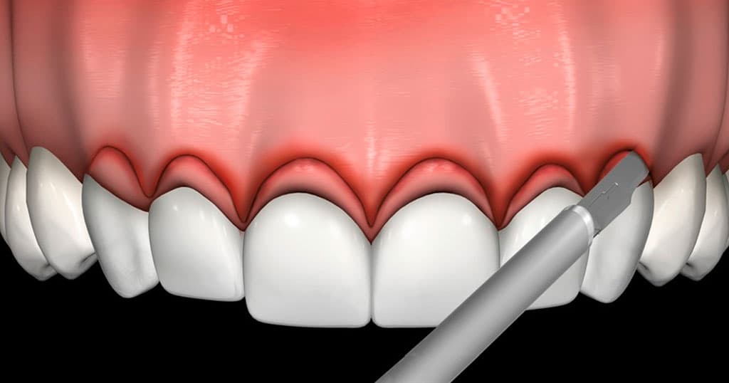 fibrotomia supracrestal en tacna