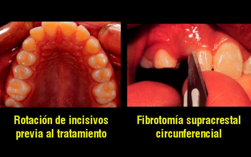 fibrotomia supracrestal indicaciones