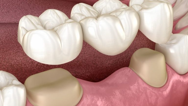 Prótesis Fija | Tipos Y Materiales - Clínica Dental Tacna