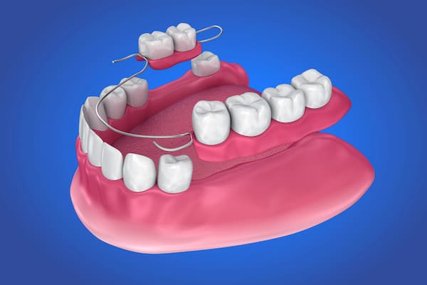 Prótesis total removible acrílico (dientes postizos totales removibles  acrílicos)