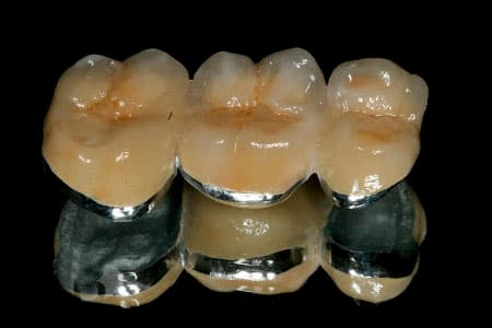 puente dental con base metalica