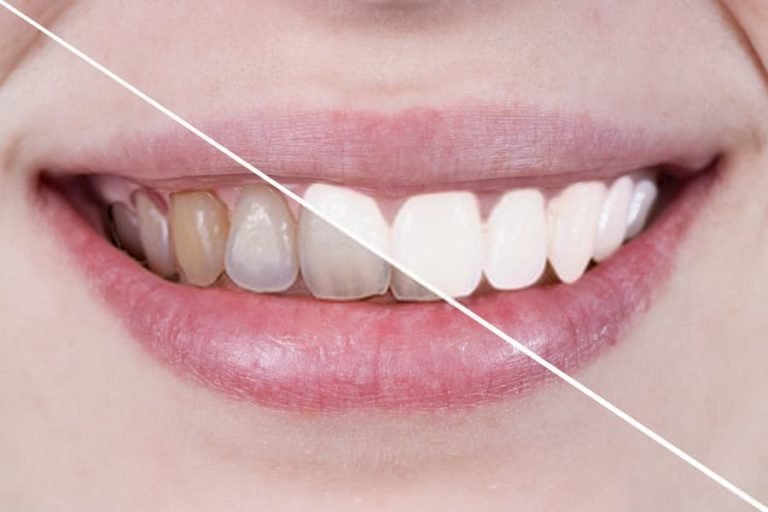 ¿Qué es el Blanqueamiento dental interno? Clínica Dental Tacna