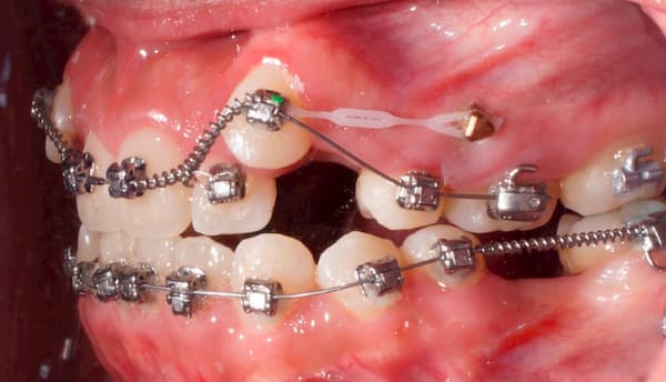 Ortodoncia con Mini implantes 3 cuando se usan los mini implantes en ortodoncia