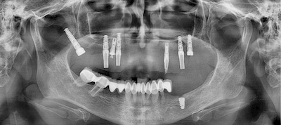 Implantes Dentales Pterigoideos 2 que es el implante pterigoideo