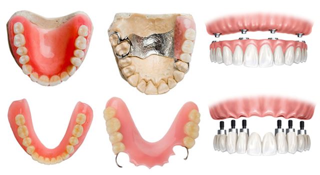 tipos de prótesis dental