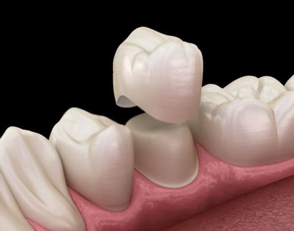 ¿Qué es el Blanqueamiento dental interno? 3 corona dental