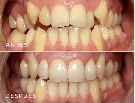 beneficios de la ortodoncia antes y despues