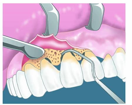 cirugía periodonta con colgajo de encias