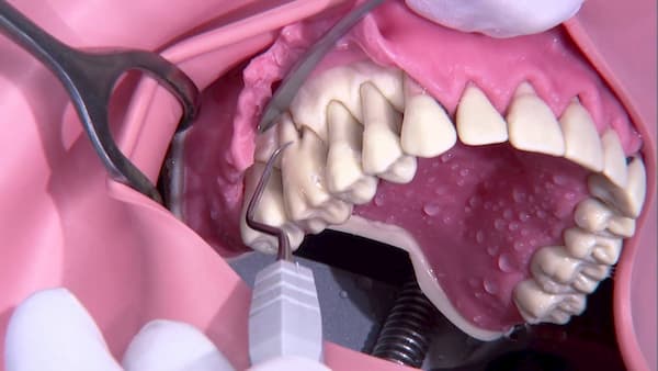 cirugia periodontal con colgajo en que consiste