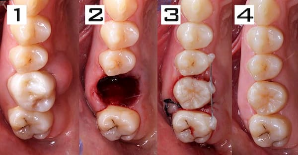 como se realiza un trasplante dental