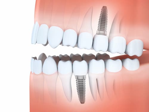 como son los implantes dentales de carga inmediata