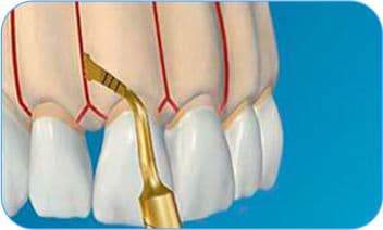 corticomia dental