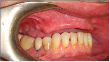 cuando se utilizan implantes dentales cigomatios