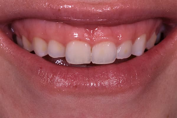 dientes cortos gingivoplastia