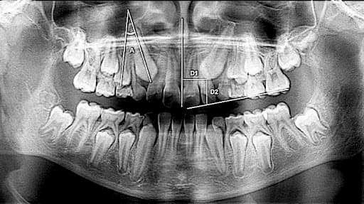 dientes retenidos radiografia